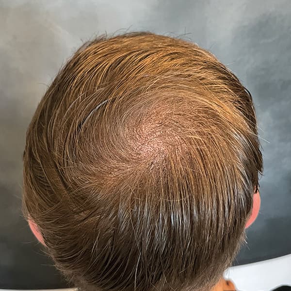 Nachher – Scalp Micropigmentation Vorher-Nachher: lichter Oberkopf durch Haarpigmentierung sichtbar verdichtet