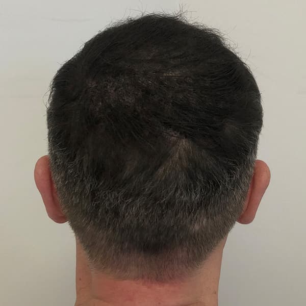 Nachher – Scalp Micropigmentation Vorher-Nachher: Haaransatz durch präzise Pigmentierung natürlich rekonstruiert