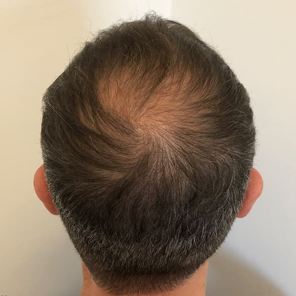 Vorher – Scalp Micropigmentation Vorher-Nachher: Haaransatz durch präzise Pigmentierung natürlich rekonstruiert