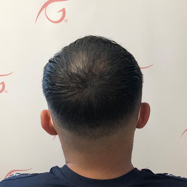 Nachher – Scalp Micropigmentation Vorher-Nachher: Tonsur am Hinterkopf durch Haarpigmentierung optisch geschlossen