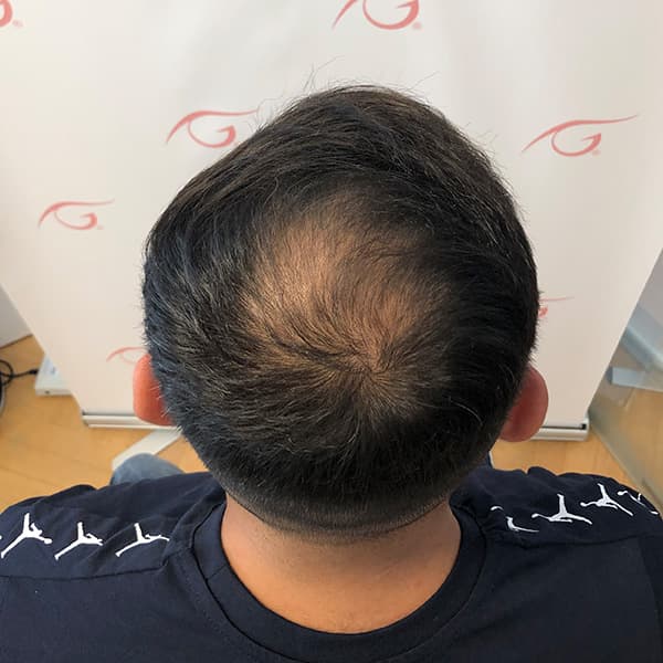 Vorher – Scalp Micropigmentation Vorher-Nachher: Tonsur am Hinterkopf durch Haarpigmentierung optisch geschlossen