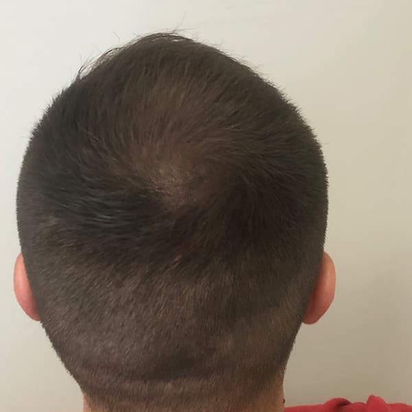 Nachher – Scalp Micropigmentation Vorher-Nachher: lichter Scheitel am Oberkopf deutlich dichter und voluminöser