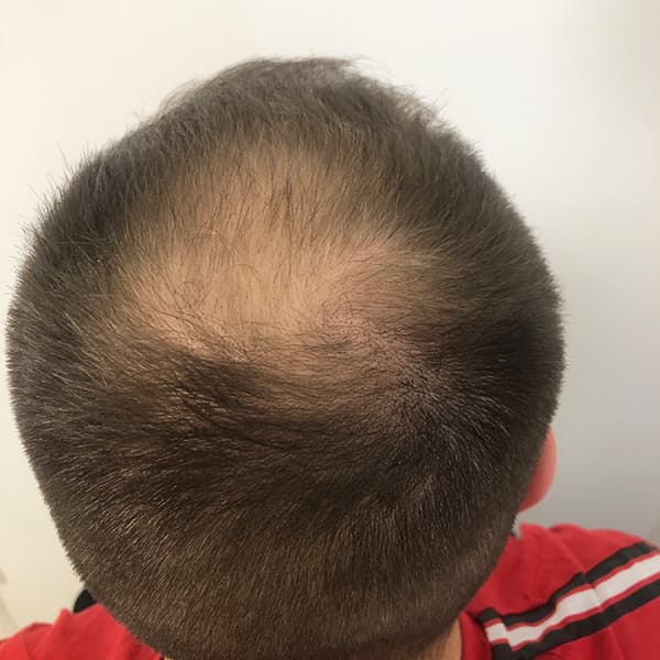 Vorher – Scalp Micropigmentation Vorher-Nachher: lichter Scheitel am Oberkopf deutlich dichter und voluminöser