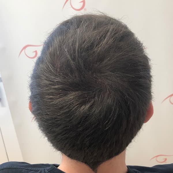 Nachher – Scalp Micropigmentation Vorher-Nachher: Geheimratsecken durch Pigmentierung natürlich aufgefüllt