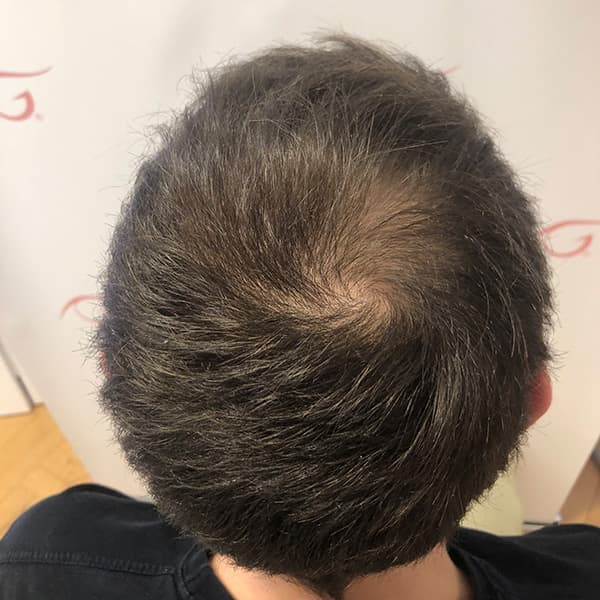Vorher – Scalp Micropigmentation Vorher-Nachher: Geheimratsecken durch Pigmentierung natürlich aufgefüllt