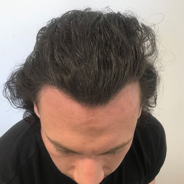 Nachher – Scalp Micropigmentation Vorher-Nachher: diffuser Haarausfall am Oberkopf gleichmäßig kaschiert