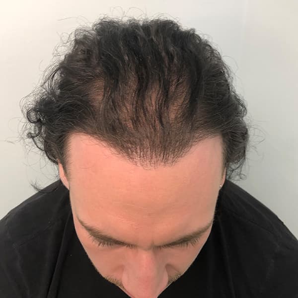Vorher – Scalp Micropigmentation Vorher-Nachher: diffuser Haarausfall am Oberkopf gleichmäßig kaschiert