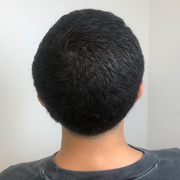 Nachher – Scalp Micropigmentation Vorher-Nachher: Kronenbereich am Oberkopf gleichmäßig verdichtet