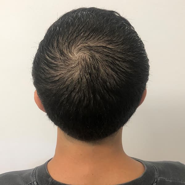 Vorher – Scalp Micropigmentation Vorher-Nachher: Kronenbereich am Oberkopf gleichmäßig verdichtet