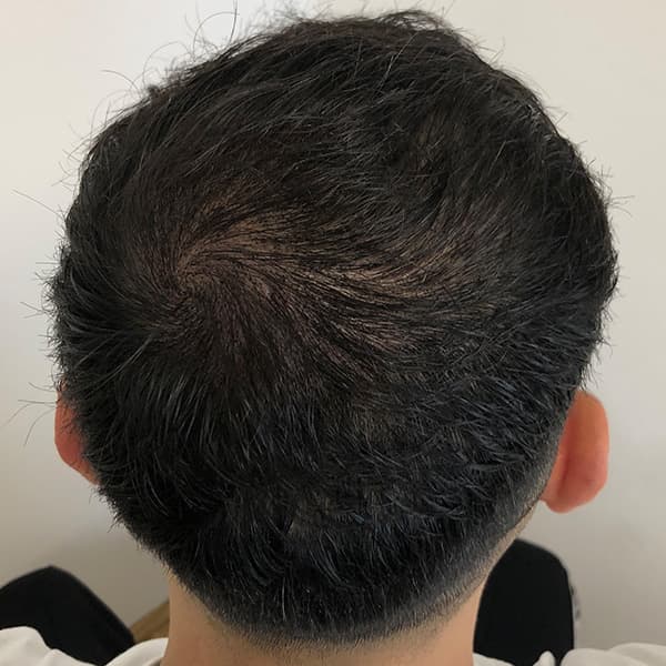 Nachher – Scalp Micropigmentation Vorher-Nachher: Stirnhaargrenze durch präzise Pigmentierung neu definiert