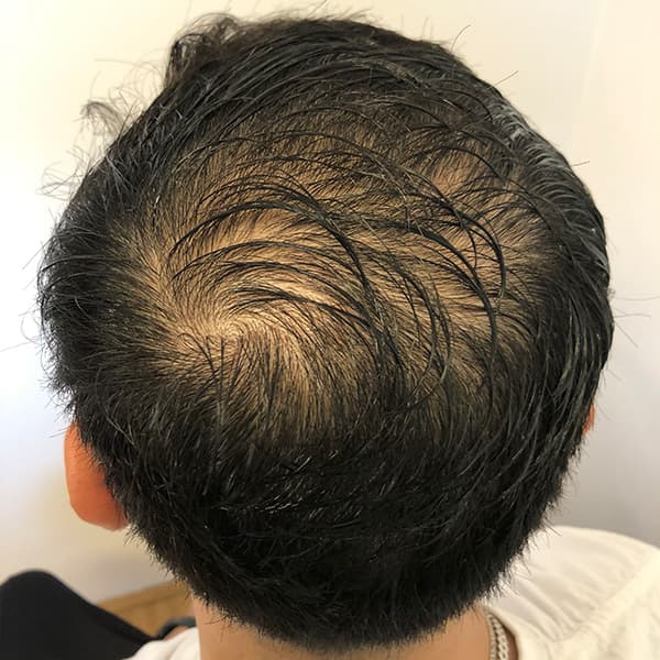 Vorher – Scalp Micropigmentation Vorher-Nachher: Stirnhaargrenze durch präzise Pigmentierung neu definiert