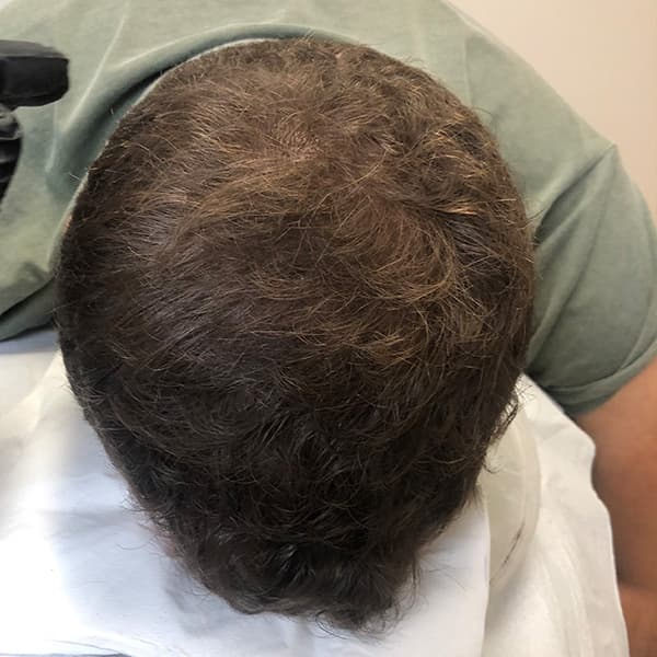 Nachher – Scalp Micropigmentation Vorher-Nachher: dünner Scheitelbereich optisch aufgefüllt und ausgeglichen