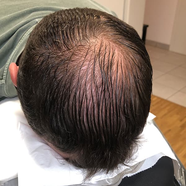 Vorher – Scalp Micropigmentation Vorher-Nachher: dünner Scheitelbereich optisch aufgefüllt und ausgeglichen