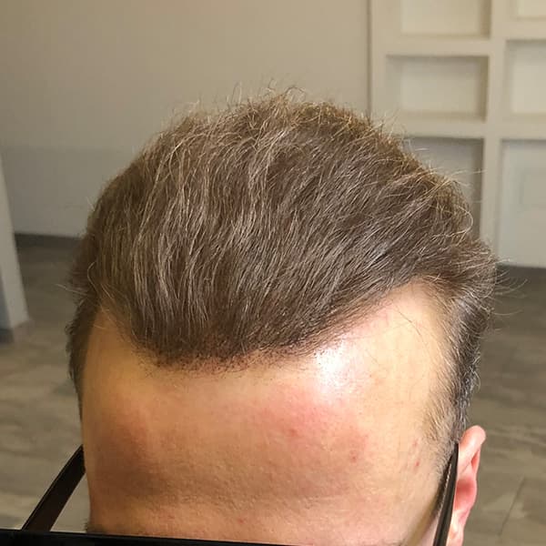 Nachher – Scalp Micropigmentation Vorher-Nachher: Haarbild am Oberkopf durch Pigmentierung sichtbar verdichtet