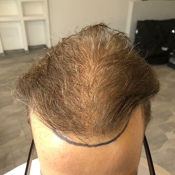 Vorher – Scalp Micropigmentation Vorher-Nachher: Haarbild am Oberkopf durch Pigmentierung sichtbar verdichtet
