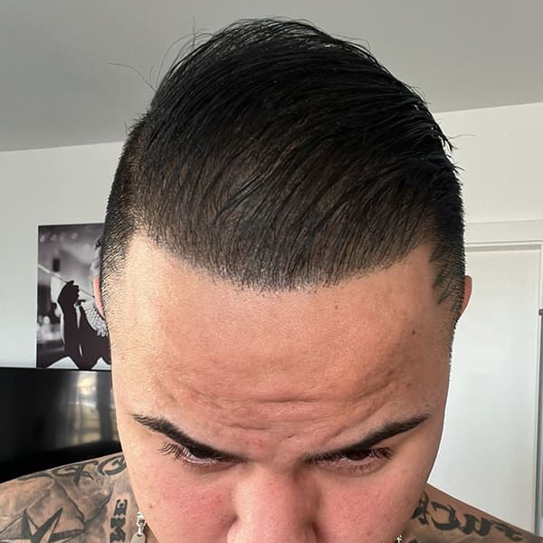Nachher – Scalp Micropigmentation Vorher-Nachher: Geheimratsecken bei lockigem Haar natürlich aufgefüllt