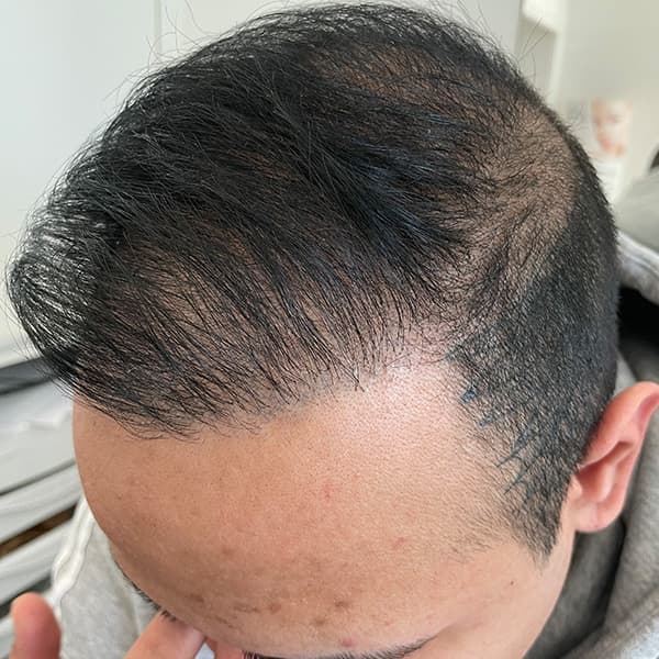 Vorher – Scalp Micropigmentation Vorher-Nachher: Geheimratsecken bei lockigem Haar natürlich aufgefüllt