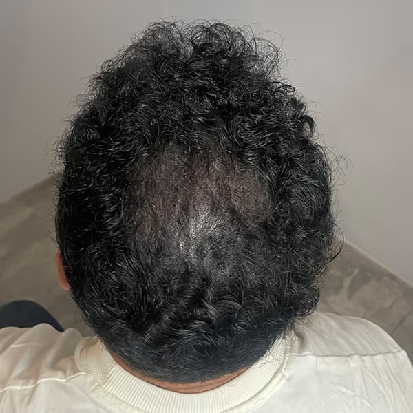 Nachher – Scalp Micropigmentation Vorher-Nachher: Hinterkopf durch Haarpigmentierung vollständig verdichtet