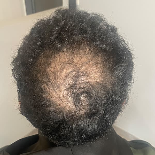 Vorher – Scalp Micropigmentation Vorher-Nachher: Hinterkopf durch Haarpigmentierung vollständig verdichtet