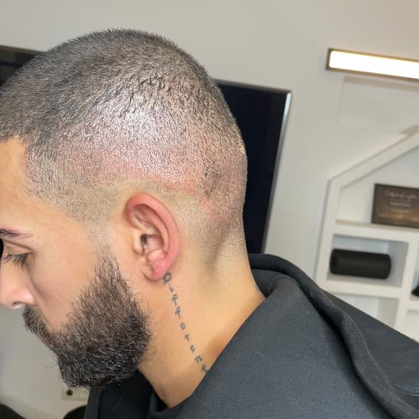 Nachher – Scalp Micropigmentation Vorher-Nachher: natürlich dichteres, gleichmäßiges Haarbild nach der Behandlung