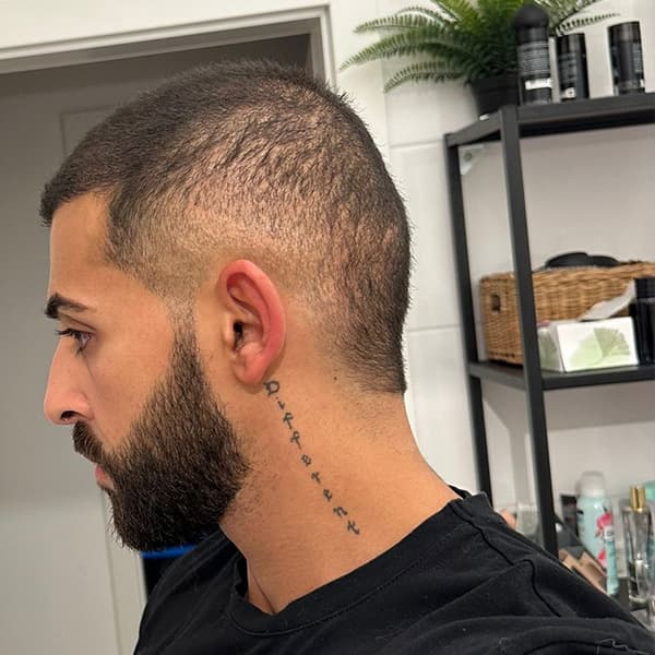 Vorher – Scalp Micropigmentation Vorher-Nachher: natürlich dichteres, gleichmäßiges Haarbild nach der Behandlung