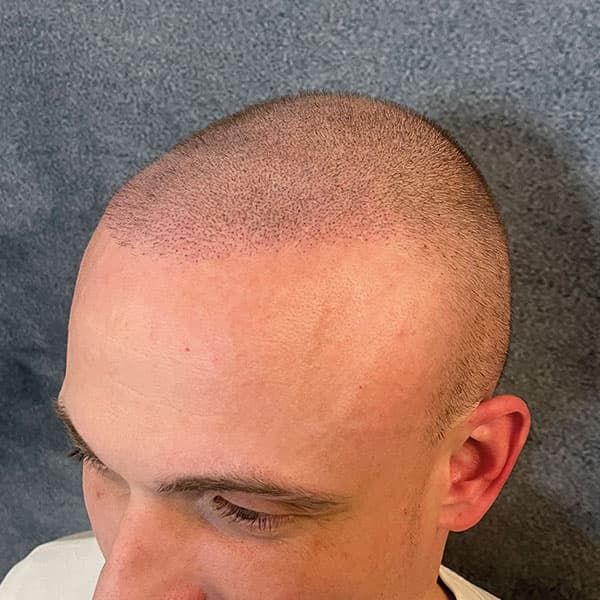 Nachher – Scalp Micropigmentation Shavelook Vorher-Nachher: dichte, gleichmäßige Pigmentierung über den gesamten Kopf