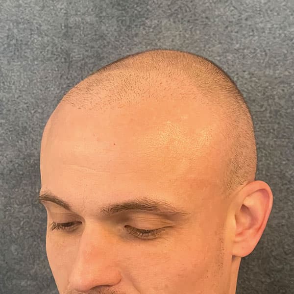Vorher – Scalp Micropigmentation Shavelook Vorher-Nachher: dichte, gleichmäßige Pigmentierung über den gesamten Kopf