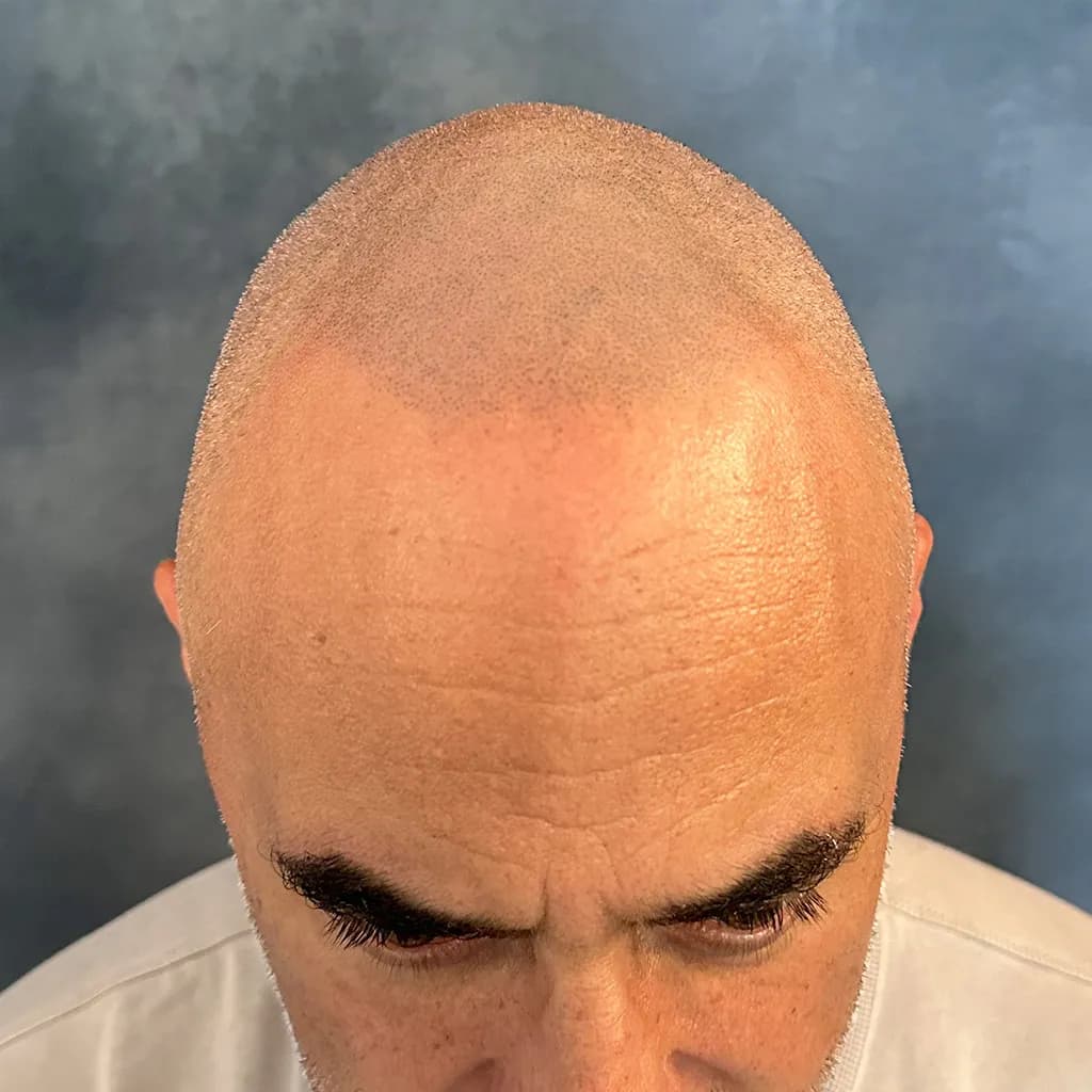 Nachher – Scalp Micropigmentation Shavelook Vorher-Nachher: Vollglatze in einen gleichmäßig dichten Shavelook mit definiertem Haaransatz verwandelt