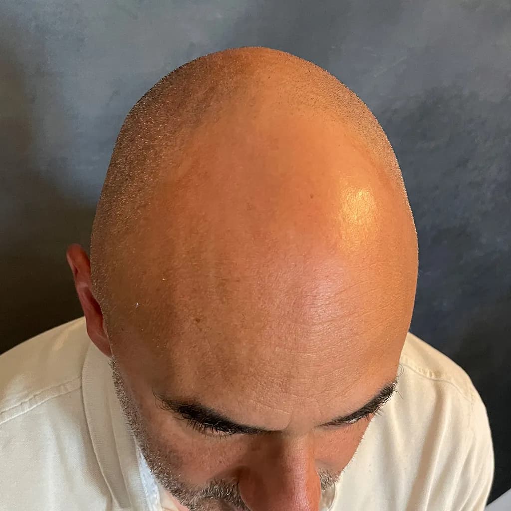 Vorher – Scalp Micropigmentation Shavelook Vorher-Nachher: Vollglatze in einen gleichmäßig dichten Shavelook mit definiertem Haaransatz verwandelt