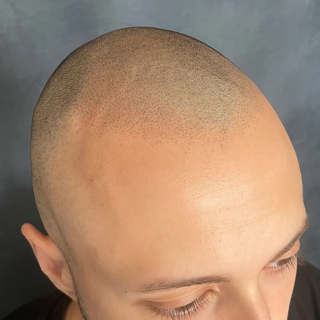 Nachher – Scalp Micropigmentation Shavelook Vorher-Nachher: zurückgewichener Haaransatz im Shavelook präzise und natürlich neu aufgebaut