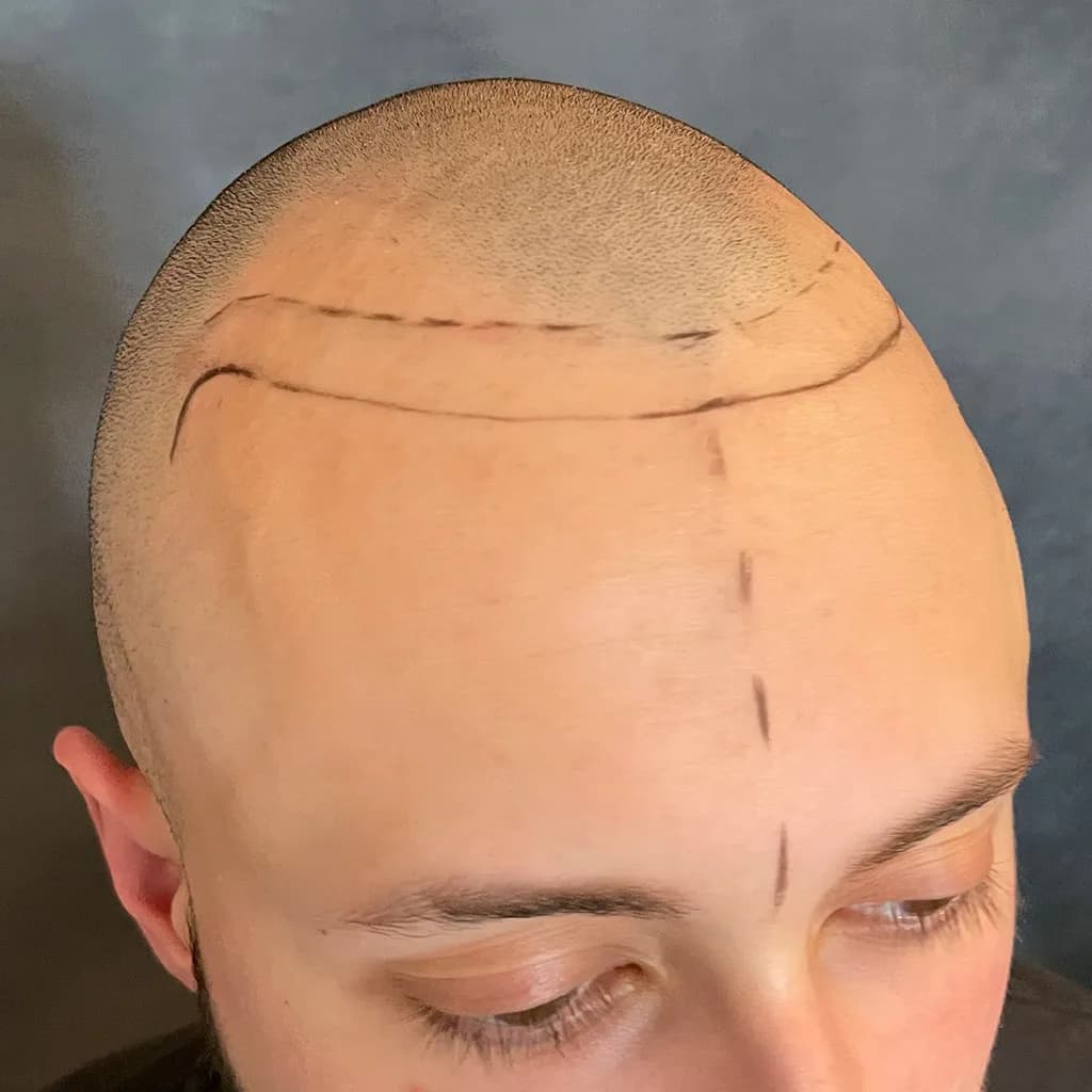 Vorher – Scalp Micropigmentation Shavelook Vorher-Nachher: zurückgewichener Haaransatz im Shavelook präzise und natürlich neu aufgebaut