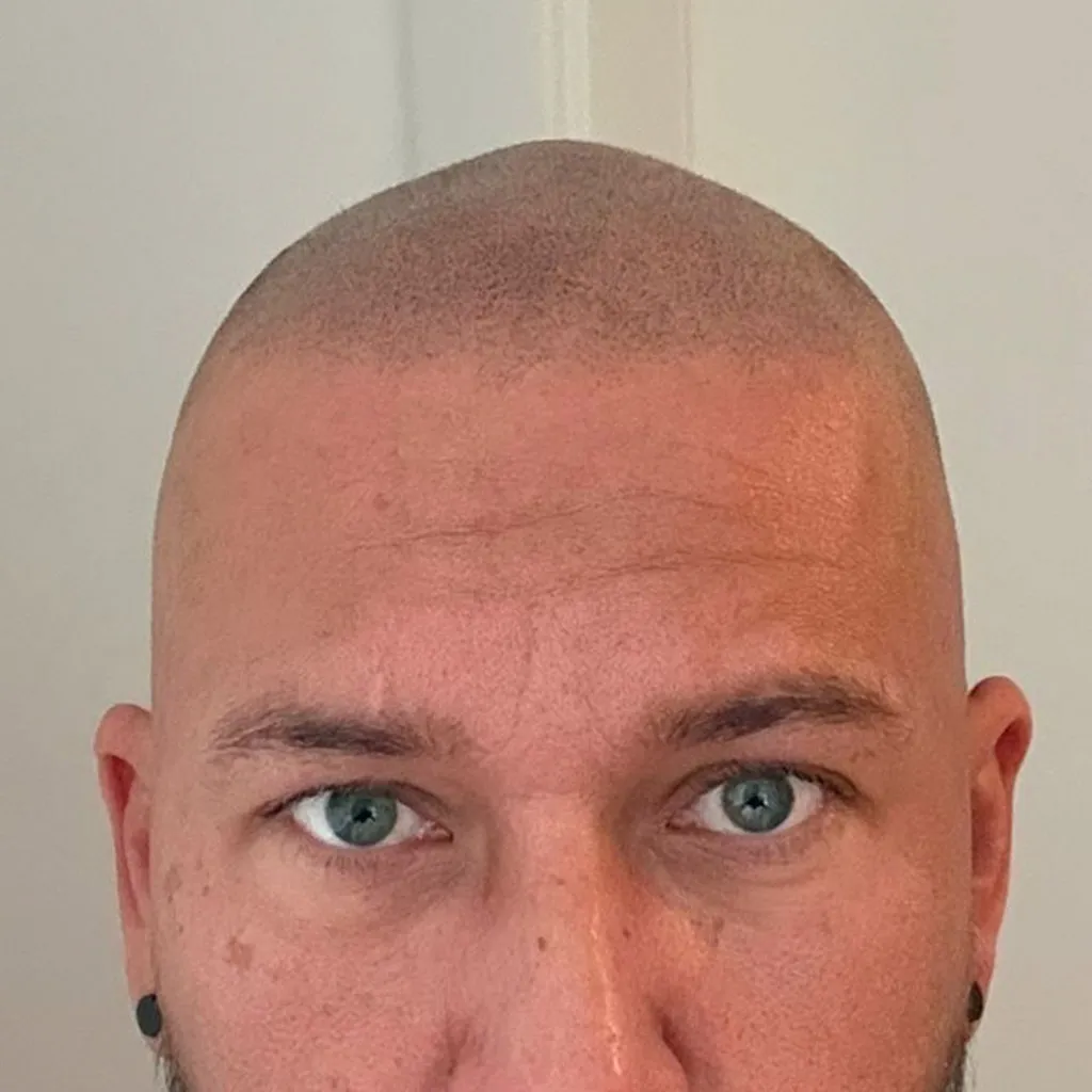 Nachher – Scalp Micropigmentation Shavelook Vorher-Nachher: kompletter Shavelook mit weich gezeichneter, natürlicher Haarlinie