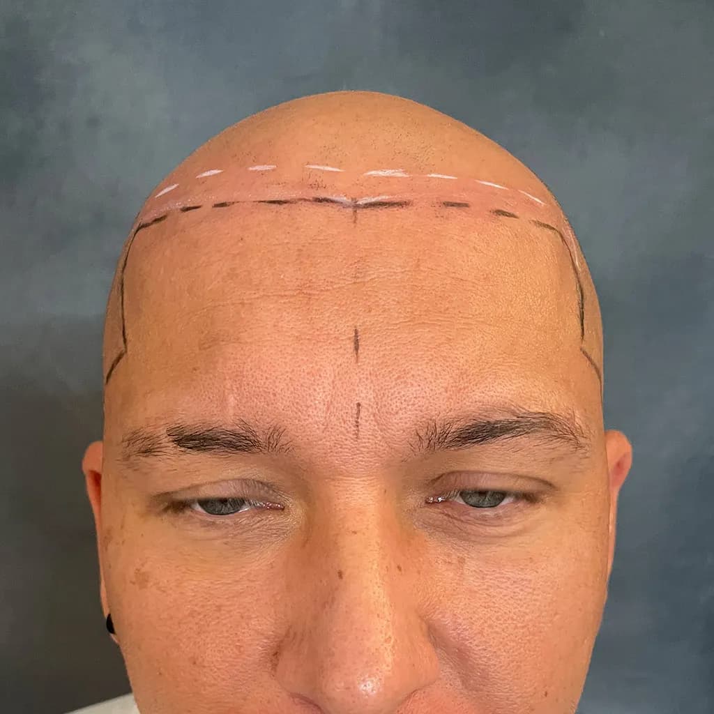 Vorher – Scalp Micropigmentation Shavelook Vorher-Nachher: kompletter Shavelook mit weich gezeichneter, natürlicher Haarlinie