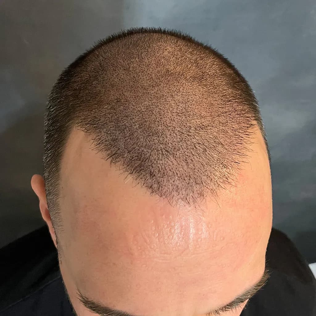 Nachher – Scalp Micropigmentation Vorher-Nachher: lichter Haaransatz und Stirnbereich bei kurzem Haar sichtbar verdichtet