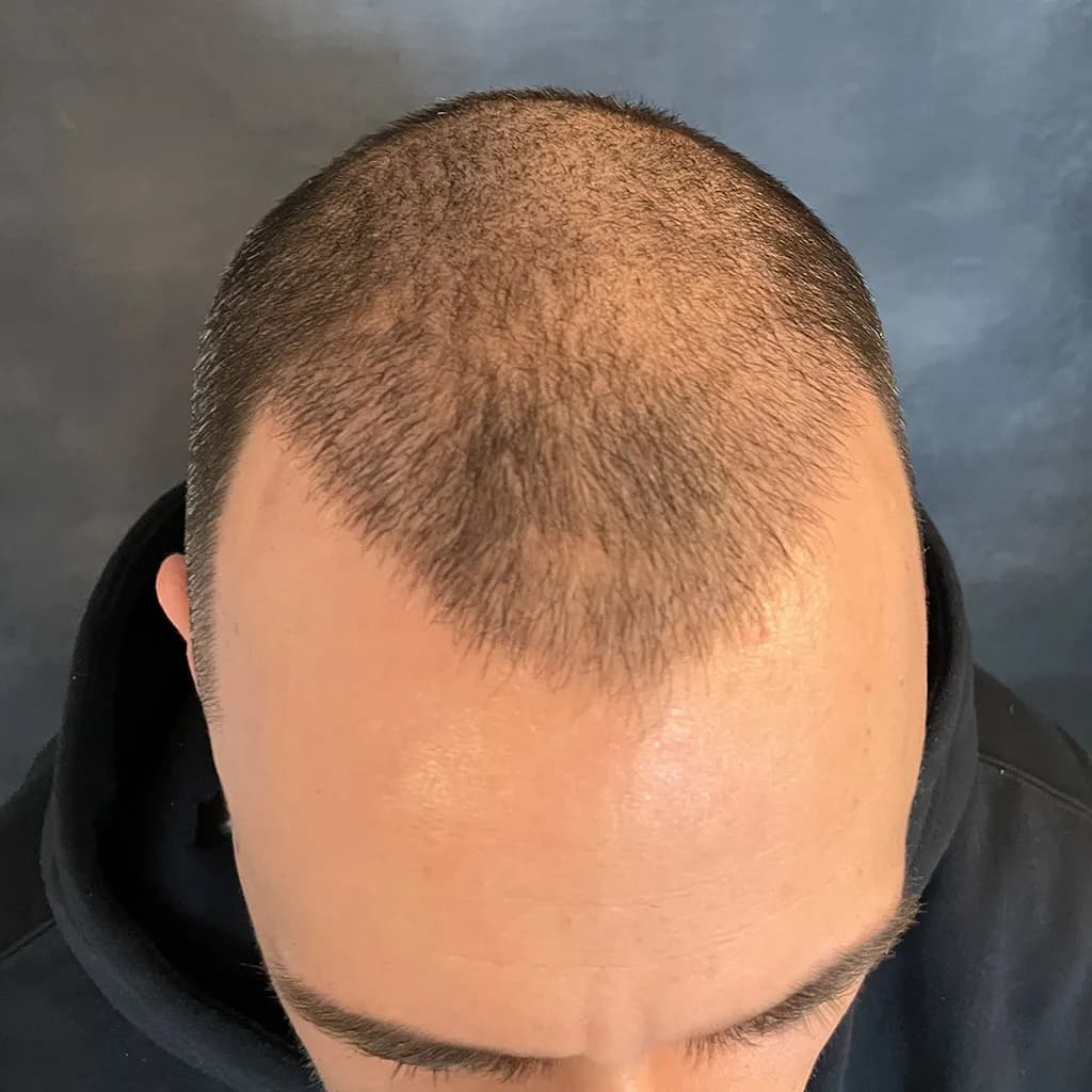Vorher – Scalp Micropigmentation Vorher-Nachher: lichter Haaransatz und Stirnbereich bei kurzem Haar sichtbar verdichtet