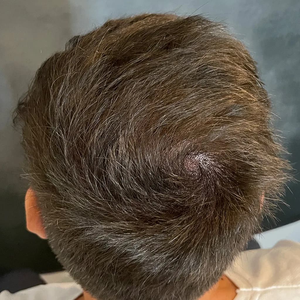 Nachher – Scalp Micropigmentation Vorher-Nachher: lichter Haarwirbel am Oberkopf durch Pigmentierung optisch geschlossen