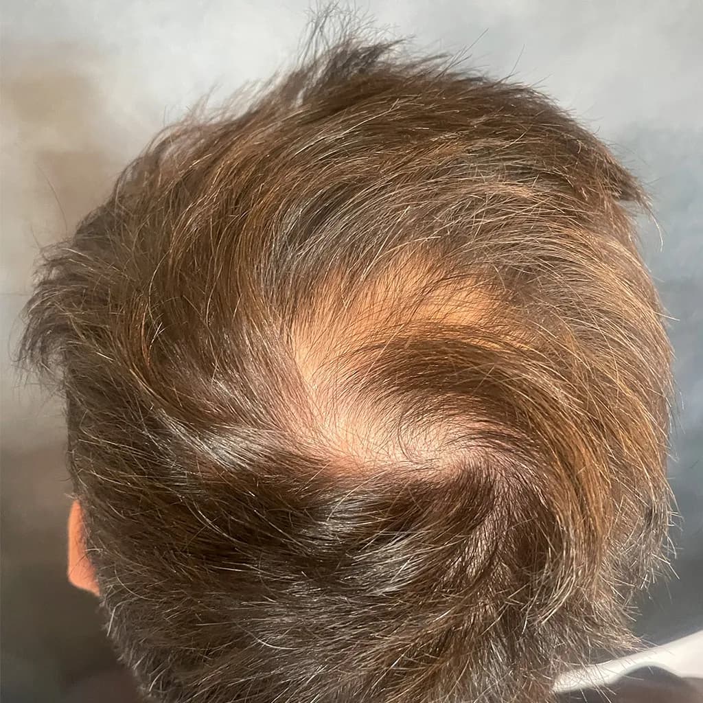 Vorher – Scalp Micropigmentation Vorher-Nachher: lichter Haarwirbel am Oberkopf durch Pigmentierung optisch geschlossen