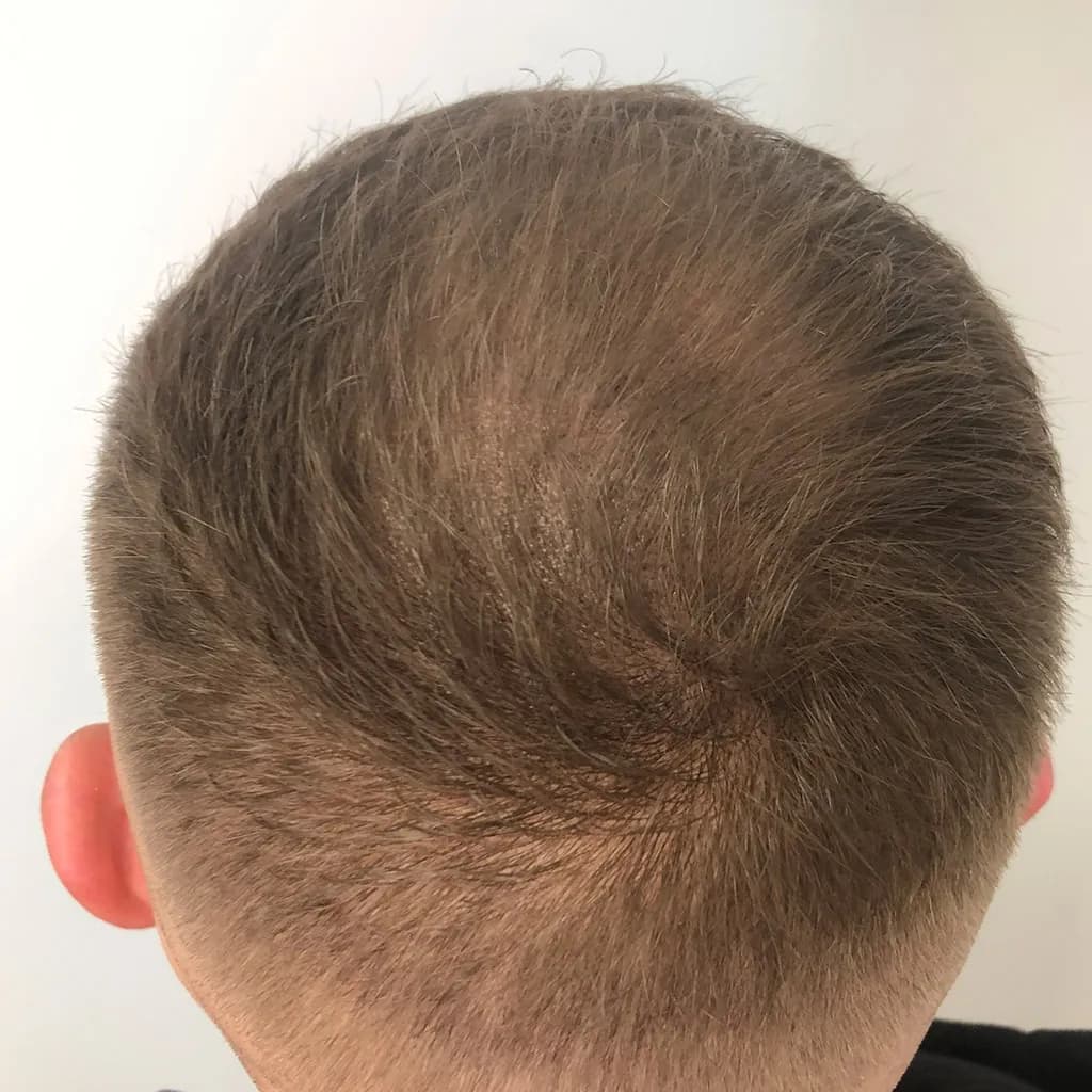 Nachher – Scalp Micropigmentation Vorher-Nachher: lichte Tonsur am Oberkopf durch Haarpigmentierung sichtbar verdichtet