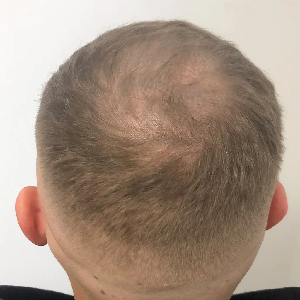 Vorher – Scalp Micropigmentation Vorher-Nachher: lichte Tonsur am Oberkopf durch Haarpigmentierung sichtbar verdichtet