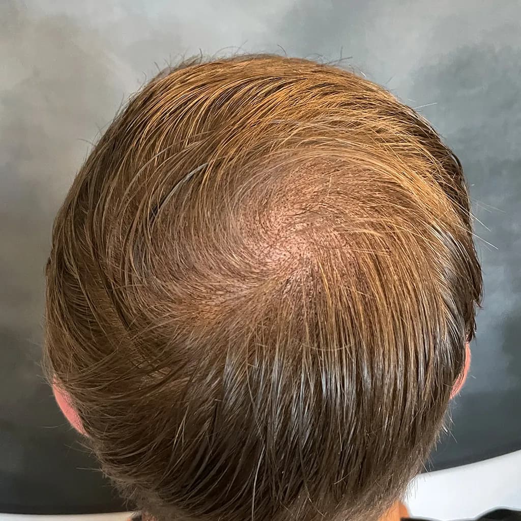 Nachher – Scalp Micropigmentation Vorher-Nachher: diffus lichter Oberkopf bei längerem Haar optisch aufgefüllt