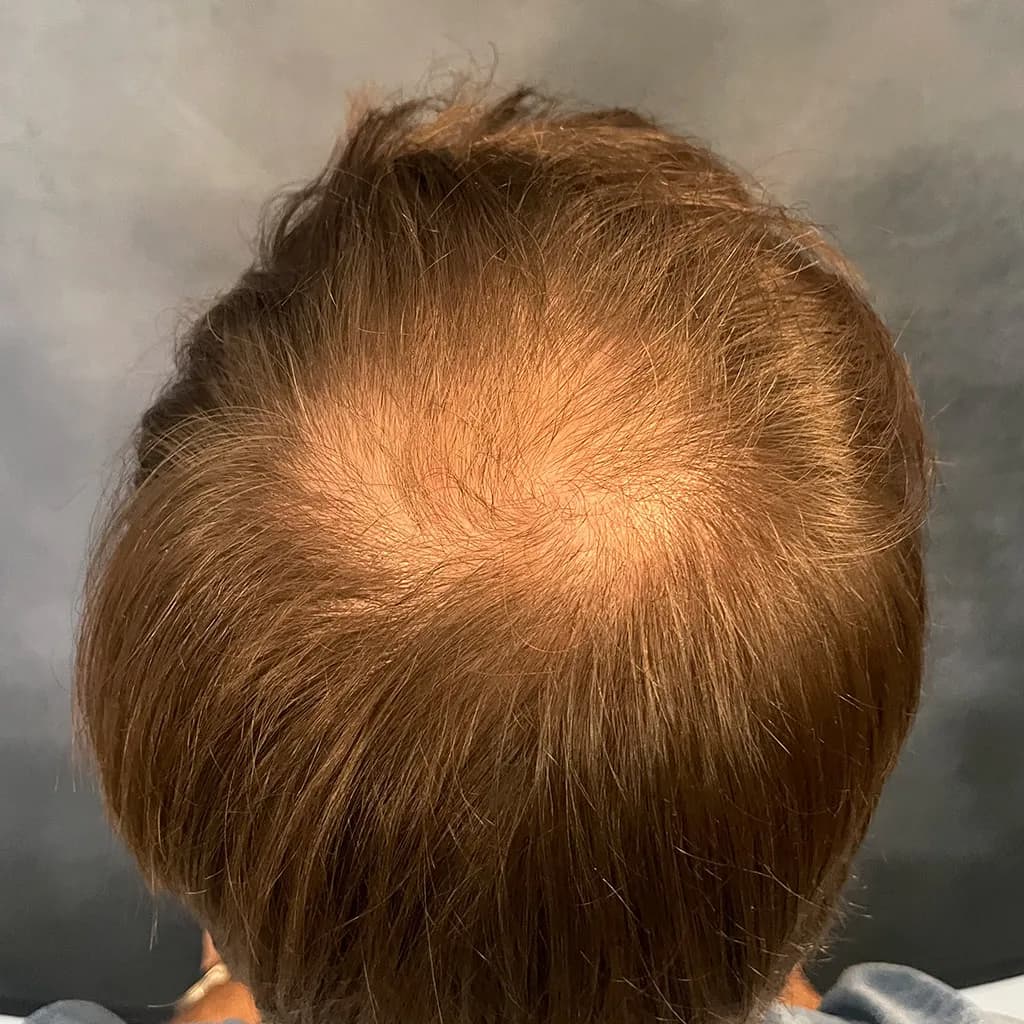 Vorher – Scalp Micropigmentation Vorher-Nachher: diffus lichter Oberkopf bei längerem Haar optisch aufgefüllt