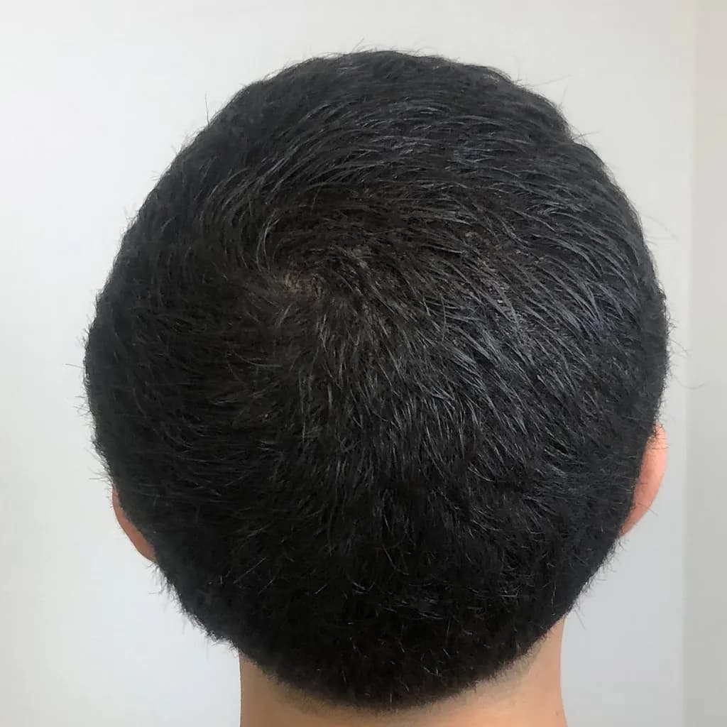 Nachher – Scalp Micropigmentation Vorher-Nachher: lichter Wirbelbereich bei dunklem Haar gleichmäßig verdichtet