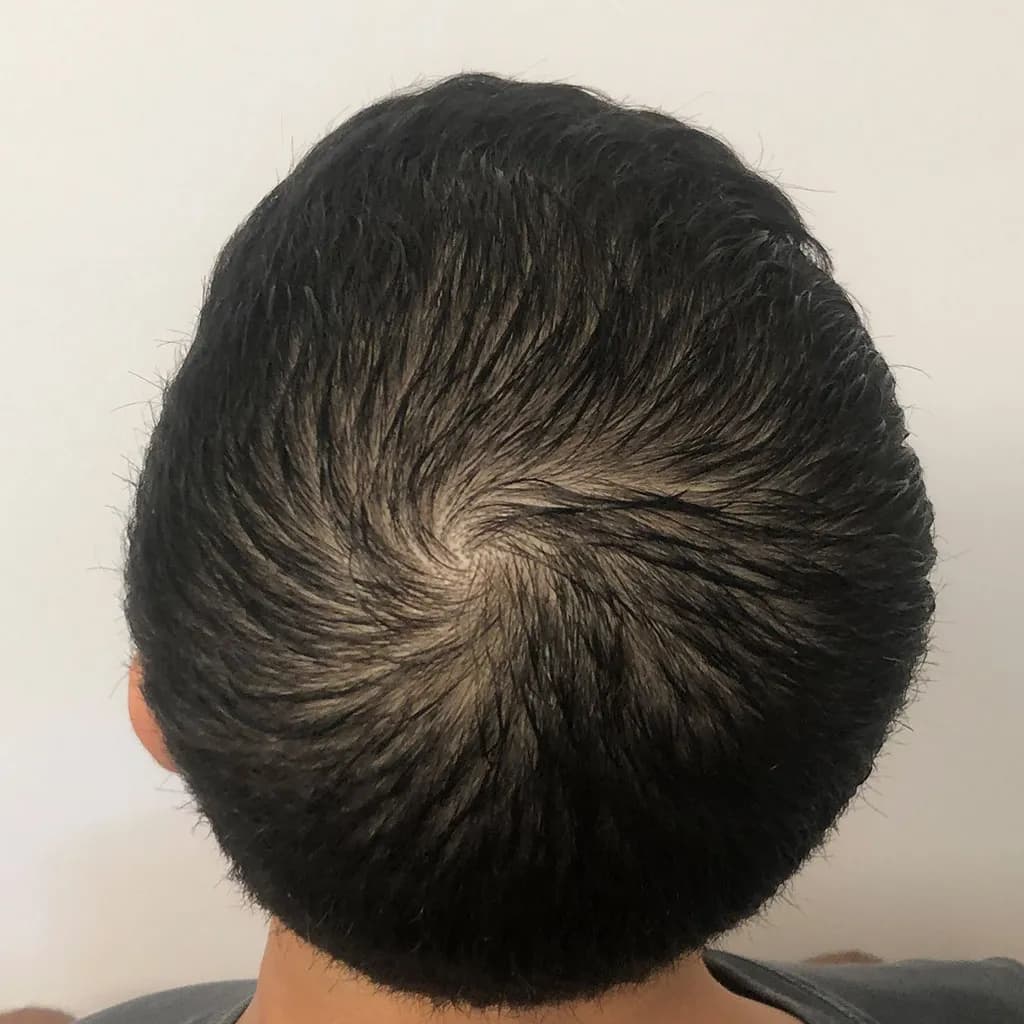 Vorher – Scalp Micropigmentation Vorher-Nachher: lichter Wirbelbereich bei dunklem Haar gleichmäßig verdichtet
