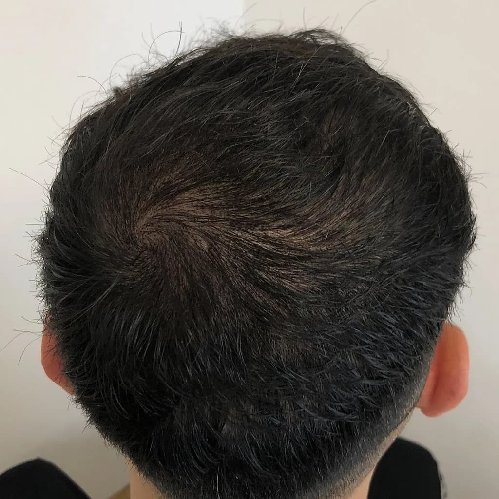 Nachher – Scalp Micropigmentation Vorher-Nachher: stark lichter Scheitel- und Wirbelbereich deutlich kaschiert