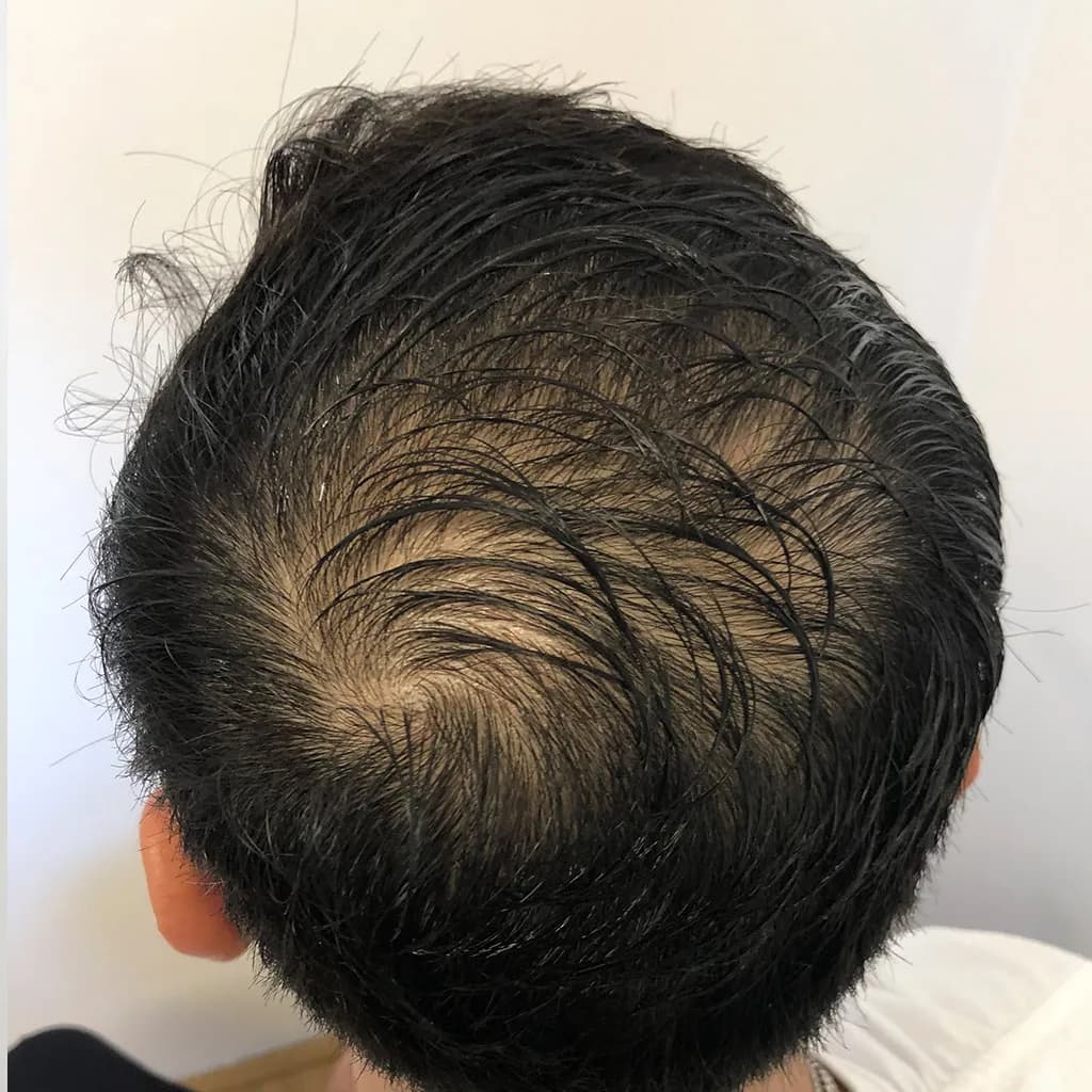Vorher – Scalp Micropigmentation Vorher-Nachher: stark lichter Scheitel- und Wirbelbereich deutlich kaschiert