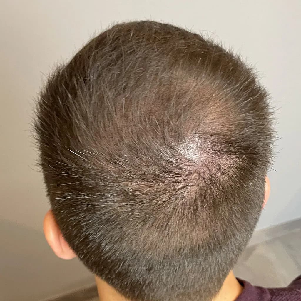 Nachher – Scalp Micropigmentation Vorher-Nachher: lichter Kronenbereich am Hinterkopf gleichmäßig aufgefüllt