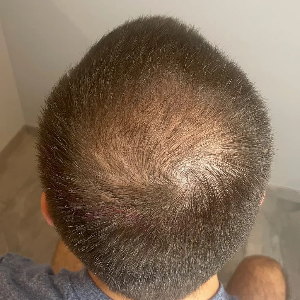 Vorher – Scalp Micropigmentation Vorher-Nachher: lichter Kronenbereich am Hinterkopf gleichmäßig aufgefüllt